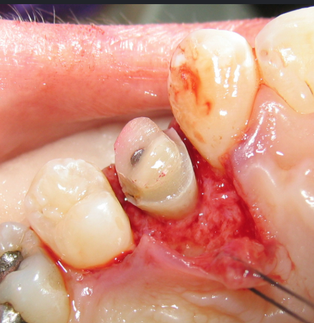 Crown Lengthening